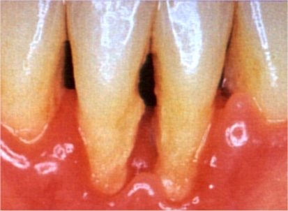Periodontitis