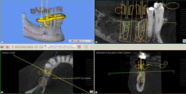 Computer Guided Implant Surgery