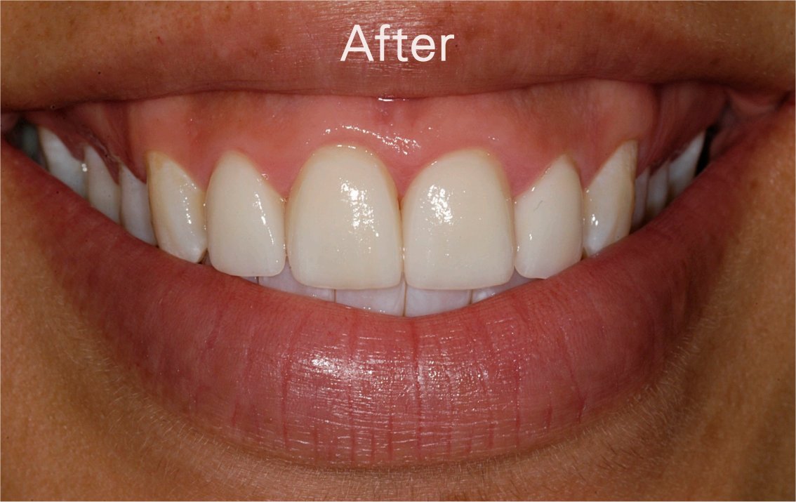 discoloured teeth after