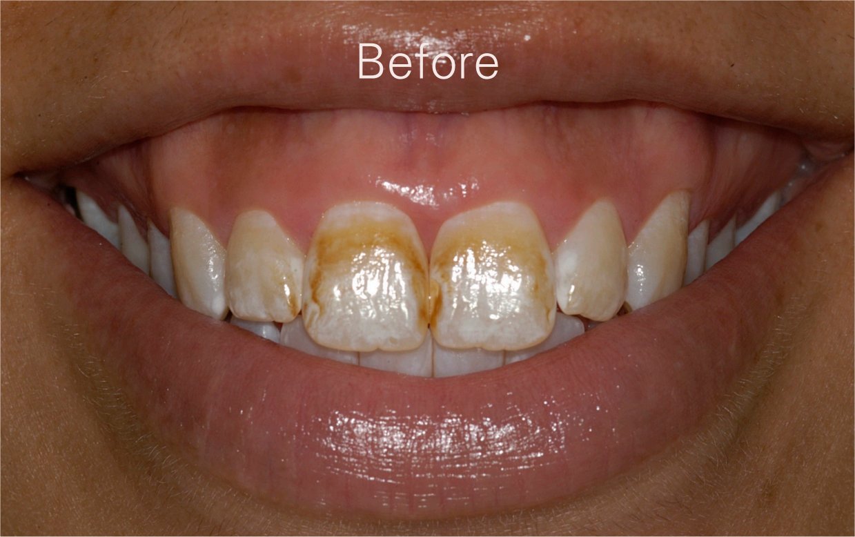 discoloured teeth before