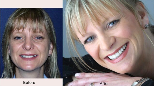 Porcelain Veneers Gallery